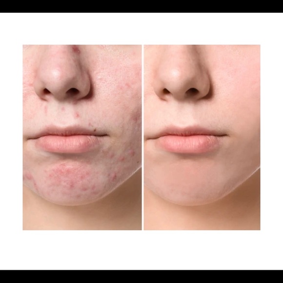 SOLD - LUXSKIN Microdermabrasian Kit - Picture 3 of 4